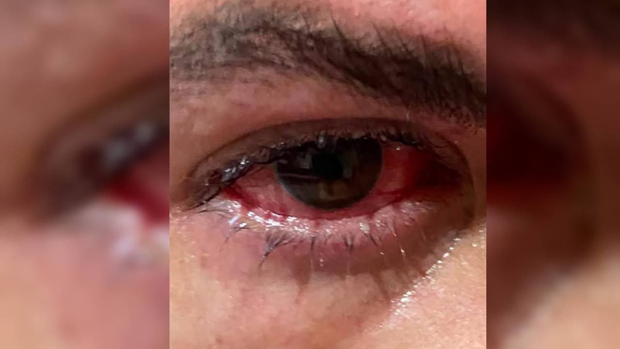 Göz tansiyonu yüzünden 19 yaşında 8 ameliyat gerçekleşti