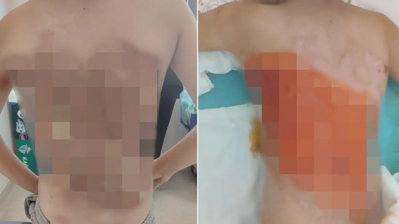 Arnavutköy'de akran zorbalığı! 12 yaşındaki çocuğun sırtını kolonya ile yaktılar